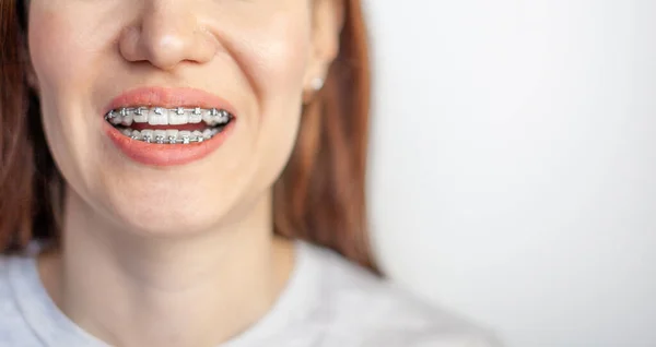 Sorriso Uma Jovem Com Aparelho Nos Dentes Brancos Dentes Endireitar — Fotografia de Stock