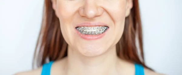 Mujer Sonríe Mostrando Sus Dientes Blancos Con Aparatos Ortopédicos Incluso —  Fotos de Stock