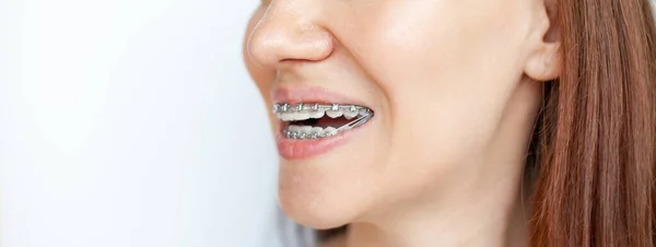 Kvinnan Ler Och Visar Sina Vita Tänder Med Tandställning Även — Stockfoto