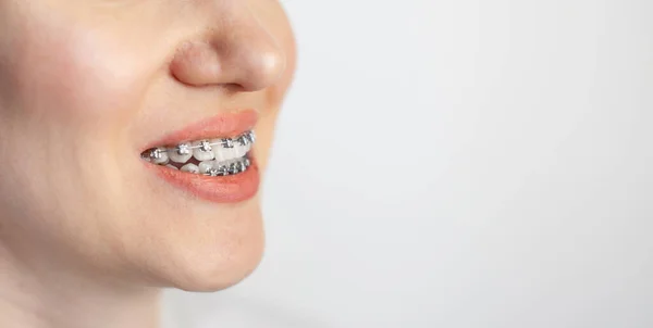Uśmiech Młodej Dziewczyny Aparatem Zębach Prostowanie Zębów Niedrożność Opieka Stomatologiczna — Zdjęcie stockowe