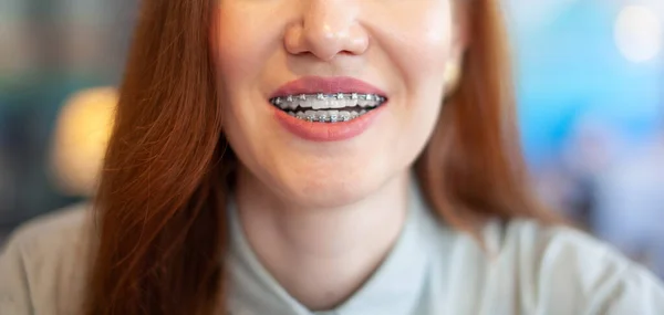 La sonrisa de una joven con aparatos ortopédicos en los dientes blancos. — Foto de Stock