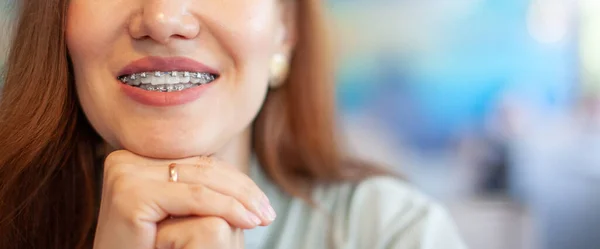 Das Lächeln eines jungen Mädchens mit Zahnspange auf ihren weißen Zähnen. — Stockfoto