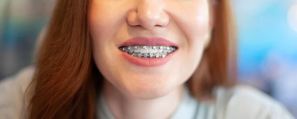 O sorriso de uma jovem com aparelho nos dentes brancos. — Fotografia de Stock