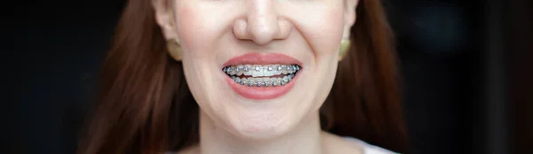 The smile of a young and beautiful girl with braces on her white teeth. Straightening of crooked teeth with the help of a bracket system. Malocclusion. Dental care. Smooth teeth and a beautiful smile