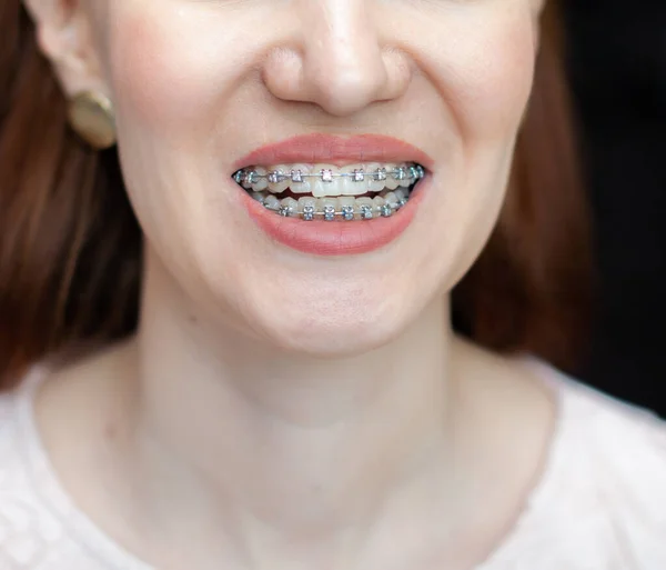 Sorriso Uma Menina Jovem Bonita Com Aparelho Nos Dentes Brancos — Fotografia de Stock