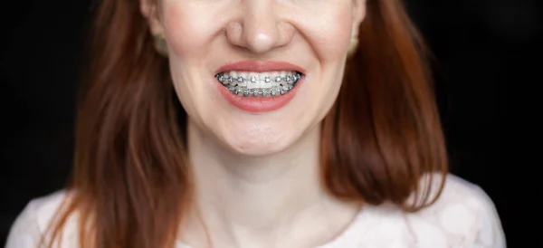 Smile Young Beautiful Girl Braces Her White Teeth Straightening Crooked — Stock Photo, Image