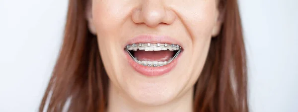 Woman Smiles Showing Her White Teeth Braces Even Teeth Wearing — Stock Photo, Image