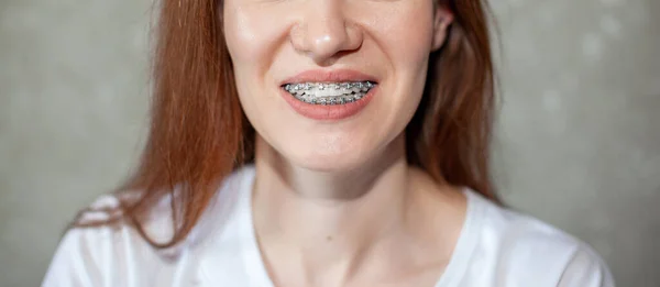 Sorriso Uma Jovem Com Aparelho Nos Dentes Brancos Dentes Endireitar — Fotografia de Stock