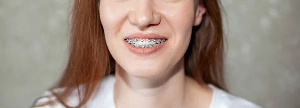 Il sorriso di una ragazza con l'apparecchio sui denti bianchi. Raddrizzamento dei denti. — Foto Stock