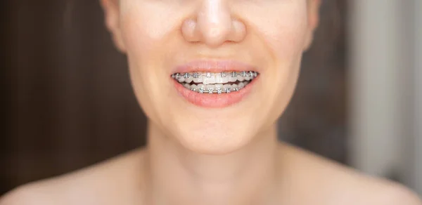 La sonrisa de una joven y hermosa chica con aparatos ortopédicos en sus dientes blancos —  Fotos de Stock