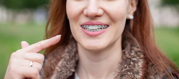 Das Mädchen zeigt mit dem Finger auf die glatten und weißen Zähne mit Zahnspange. — Stockfoto