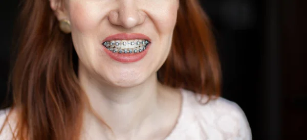 Smile Young Beautiful Girl Braces Her White Teeth Straightening Crooked — Stock Photo, Image