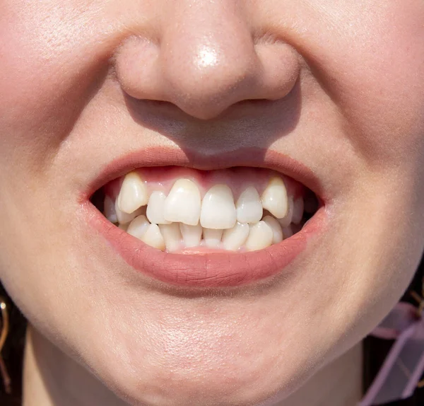 Gebogen Vrouwelijke Tanden Voor Het Installeren Van Beugels Close Van — Stockfoto