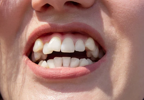 Dientes Femeninos Curvados Antes Instalar Aparatos Ortopédicos Cierre Dientes Antes — Foto de Stock