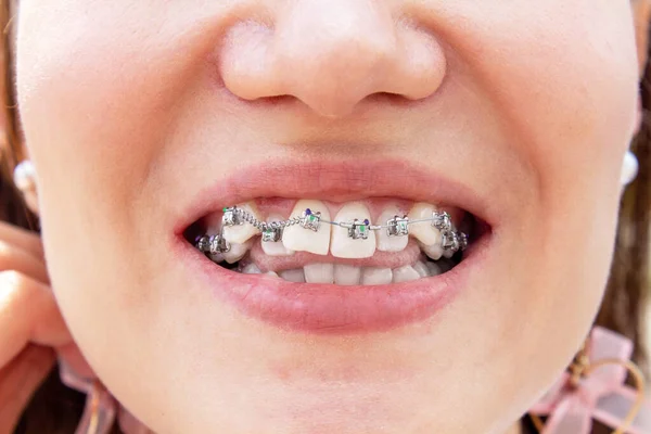 Curved female teeth, after installing braces. Close-up of the teeth after treatment at the orthodontist.Brasket system in a girl\'s smiling mouth, macro photography of teeth. Braces on the girl\'s teeth