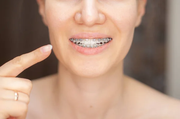 Chica Señala Con Dedo Los Dientes Uniformes Blancos Con Aparatos —  Fotos de Stock