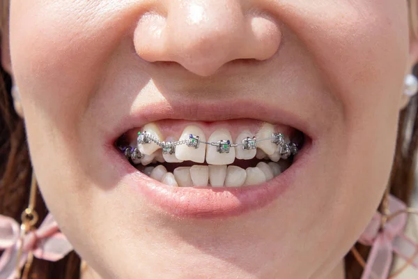 Curved female teeth, after installing braces. Close-up of the teeth after treatment at the orthodontist.Brasket system in a girl\'s smiling mouth, macro photography of teeth. Braces on the girl\'s teeth