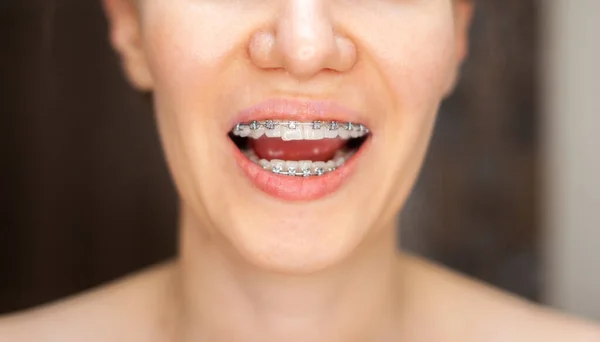 Улыбка Молодой Красивой Девушки Брекетами Белых Зубах Выпрямление Кривых Зубов — стоковое фото