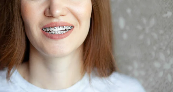 Sorriso Uma Menina Jovem Bonita Com Aparelho Nos Dentes Brancos — Fotografia de Stock