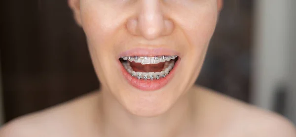 Sorriso Uma Menina Jovem Bonita Com Aparelho Nos Dentes Brancos — Fotografia de Stock
