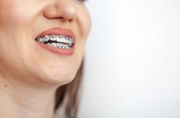Sorriso Uma Jovem Com Aparelho Nos Dentes Brancos Dentes Endireitar — Fotografia de Stock
