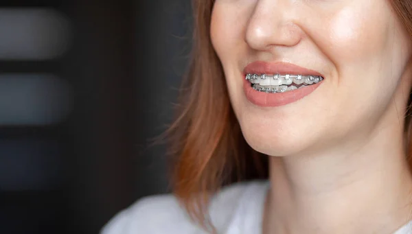 Uśmiech Młodej Pięknej Dziewczyny Aparatem Zębach Prostowanie Krzywych Zębów Pomocą — Zdjęcie stockowe