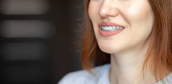 Uśmiech Młodej Pięknej Dziewczyny Aparatem Zębach Prostowanie Krzywych Zębów Pomocą — Zdjęcie stockowe