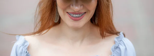 Sorriso Una Ragazza Giovane Bella Con Apparecchio Sui Denti Bianchi — Foto Stock