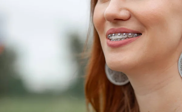 Sonrisa Una Joven Hermosa Niña Con Aparatos Ortopédicos Los Dientes — Foto de Stock