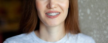 Beyaz dişlerinde diş telleri olan genç ve güzel bir kızın gülümsemesi. Eğri dişlerin düzleştirilmesi, bir ayraç sistemi yardımıyla. Maloklasyon. Diş bakımı. Pürüzsüz dişler ve güzel bir gülümseme
