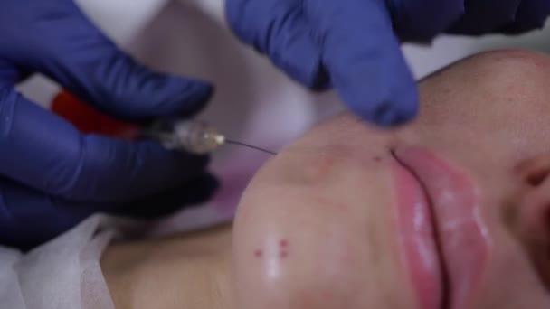 Der Arzt einer Kosmetikerin führt eine Injektion von Hyaluronsäure durch — Stockvideo
