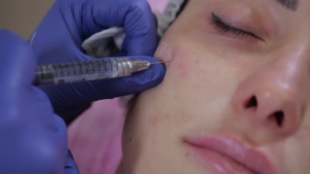 Die Kosmetikerin spritzt einer jungen Patientin Füllstoffe auf Hyaluronsäure-Basis — Stockvideo