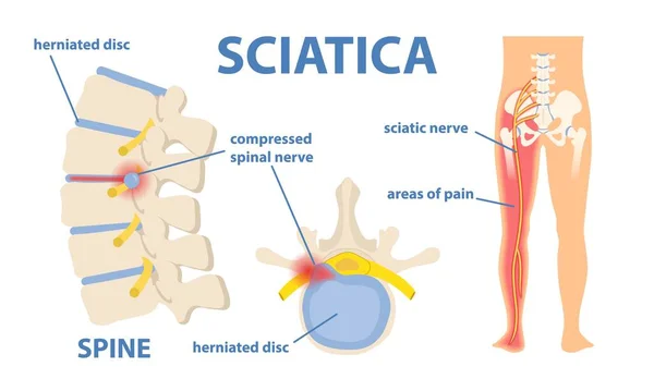 Douleurs nerveuses sciatiques — Image vectorielle