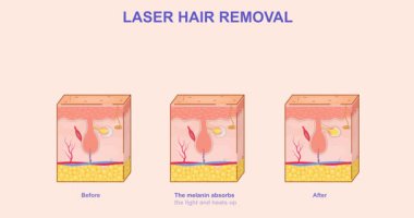 Lazer tüy aldırma. Taşıyıcı pankart deri katmanlarını ve lazer ışını kullanarak tüy çıkarma işlemini gösteriyor. Kozmetik prosedürü gösteren bilgiler. Düz grafik çizgi film