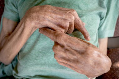 Yaşlı hastanın eli bükülmüş..