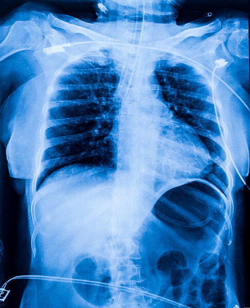 X-ray film of human female chest