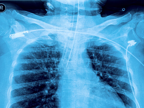 X-ray film of human female chest and spine and shoulder