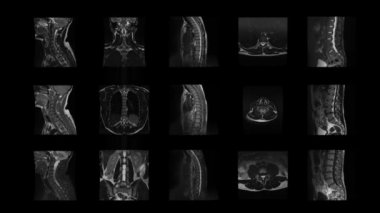 omurganın hareketli tomografi