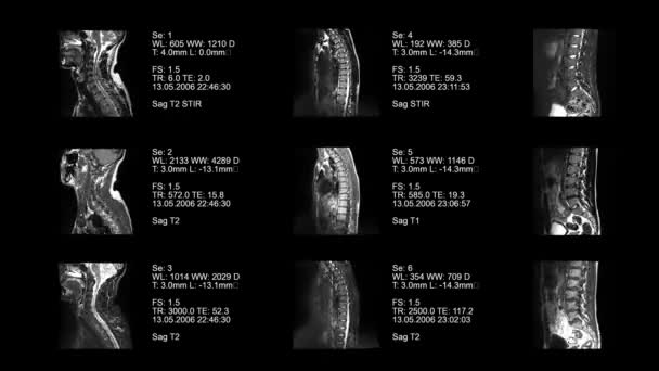 Animierte Tomographie der Wirbelsäule — Stockvideo