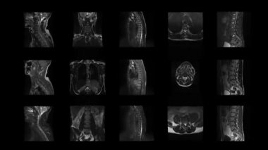 omurganın hareketli tomografi