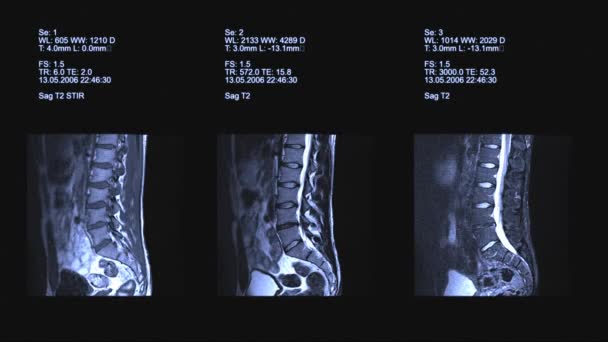 Tomographie, imagerie de la colonne vertébrale 