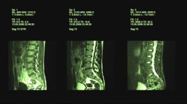 Tomografi, omurga görüntüleme