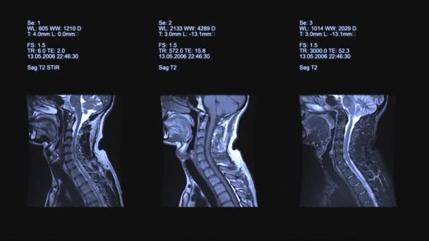 MRI tarama görünümlerini boyun — Stok video