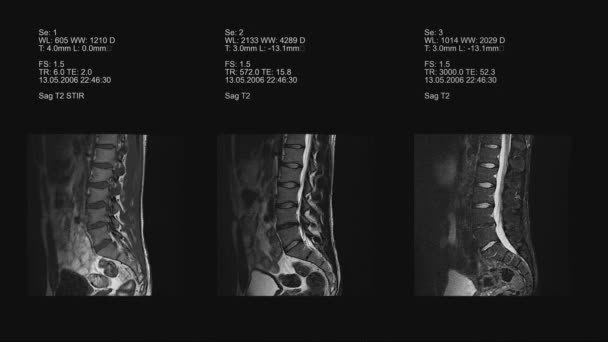Tomographie, imagerie de la colonne vertébrale 