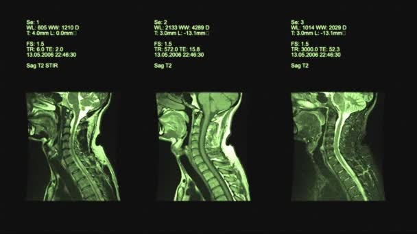 Nek uitzicht op Mri-scan — Stockvideo