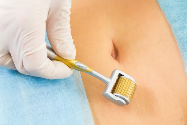 Enjeksiyon Mezoterapi göbek üzerinde