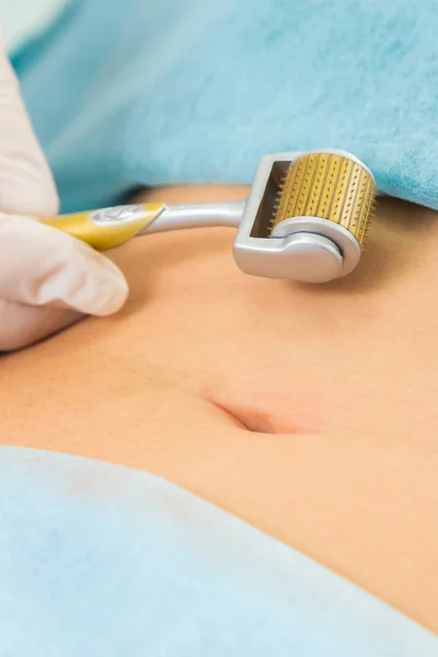 Injection mesotherapy on belly — Stock Photo, Image