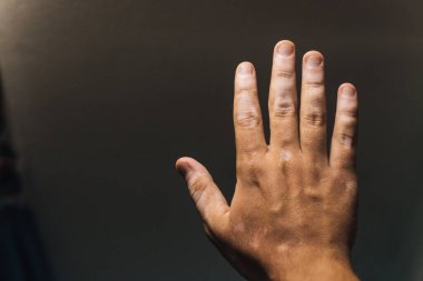 Siyah arka planda vitiligo ile el