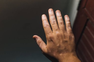 Siyah arka planda vitiligo ile el