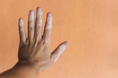 Turuncu arka planda vitiligo ile el.